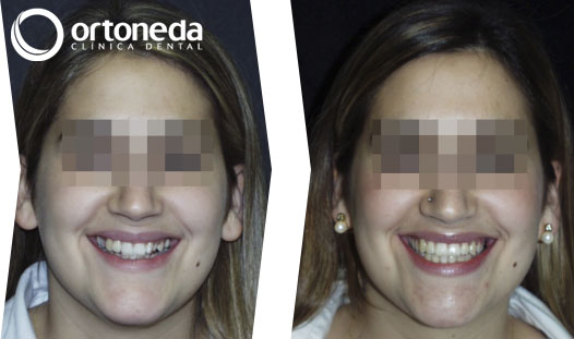 dientes_incluidos_caso_01_02