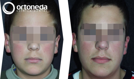 dientes_incluidos_caso_04_01
