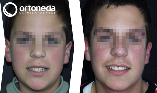 dientes_incluidos_caso_04_02