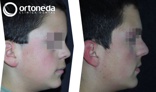 dientes_incluidos_caso_04_03