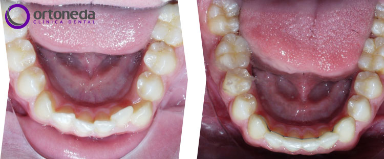 dientes_incluidos_caso_04_05