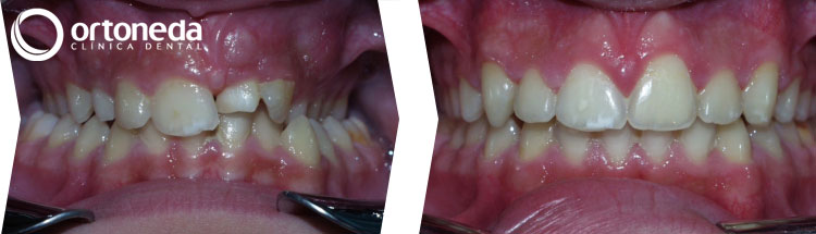 dientes_incluidos_caso_04_06