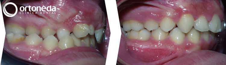 dientes_incluidos_caso_04_07