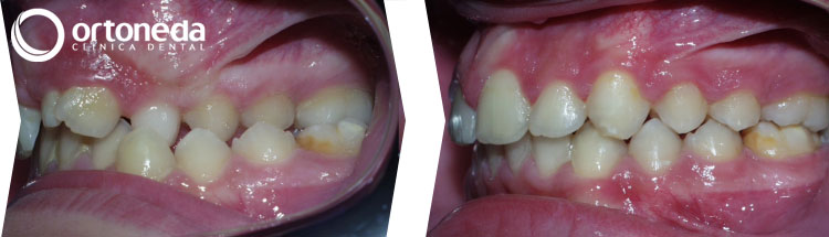 dientes_incluidos_caso_04_08