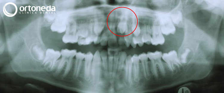 dientes_incluidos_caso_04_09