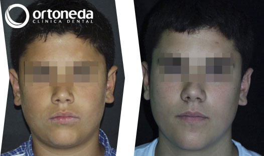 extracciones_caso_03_01