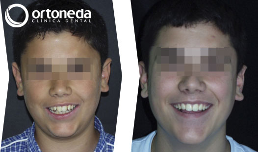 extracciones_caso_03_02