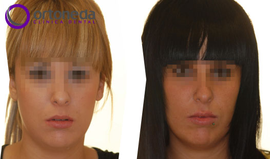 ortodoncia_adolescentes_caso_01_01 ortodoncia_adolescentes_caso_01_01