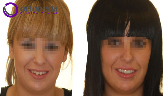 ortodoncia_adolescentes_caso_01_02 ortodoncia_adolescentes_caso_01_02