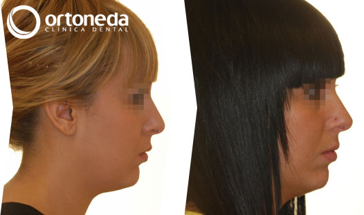 ortodoncia_adolescentes_caso_01_03 ortodoncia_adolescentes_caso_01_03