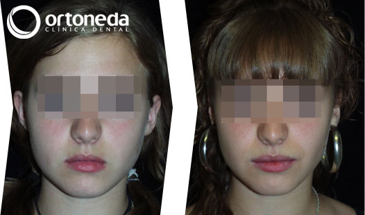 ortodoncia_adolescentes_caso_04_01