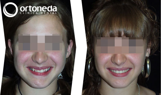 ortodoncia_adolescentes_caso_04_02