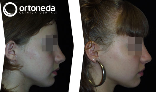 ortodoncia_adolescentes_caso_04_03