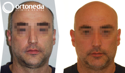 ortodoncia_adultos_caso_02_01 ortodoncia_adultos_caso_02_01