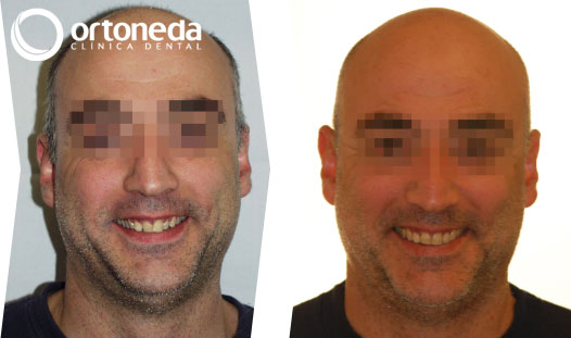 ortodoncia_adultos_caso_02_02 ortodoncia_adultos_caso_02_02
